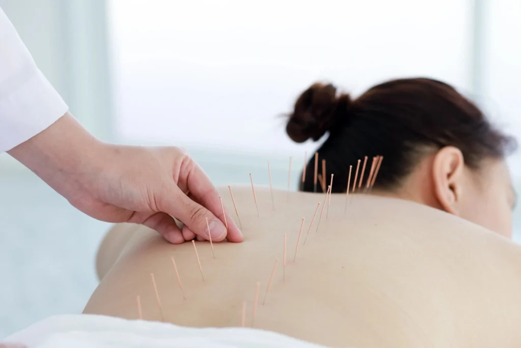 Acupuncture in Mississauga
